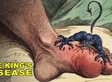The History of Gout | The Disease of Kings